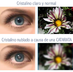 Fotografía evolucion de catarata y síntomas