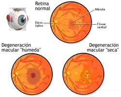 Figura ilustrativa: tipos de degeneracion macular