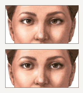 Figura ilustrativa corrección estrabismo