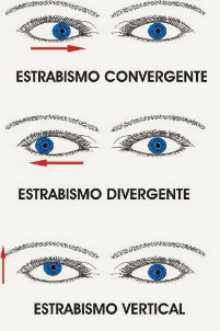 Foto: tipos de estrabismo