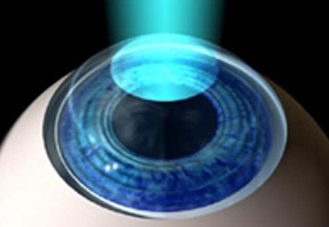 fotografía lasik
