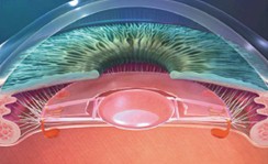 Ilustracion: lente intraocular