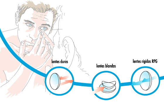 Figura ilustrativa: lentes duras, blandas y rígidas