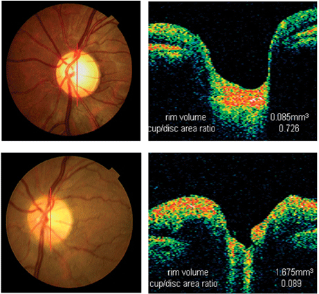 Foto: tipos de glaucoma
