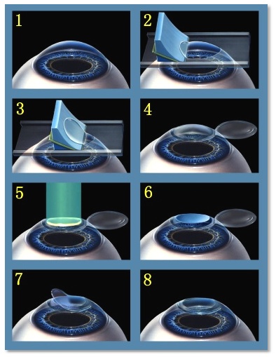 Figura ilustrativa afeccion de catarata