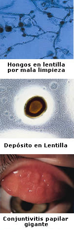 fotografas de: Hongos u depsitos en lentilla; fotografa de conjuntivitis